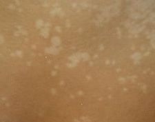 Tinea Versicolor